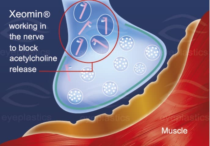 Xeomin — toxina desnuda, sin proteínas accesorias