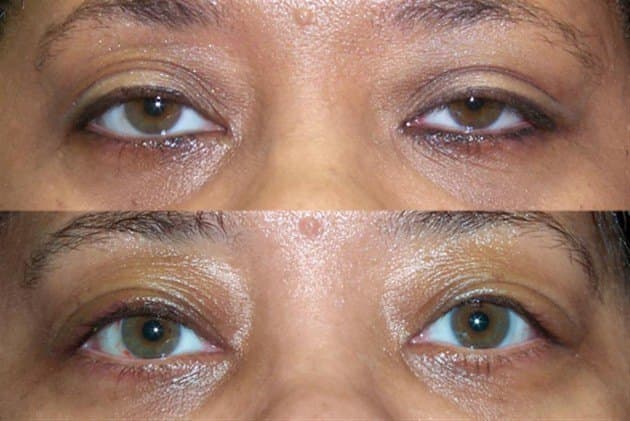 Age 45 — before and after ptosis repair