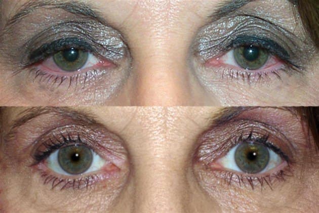 Age 50 — before and after ptosis repair