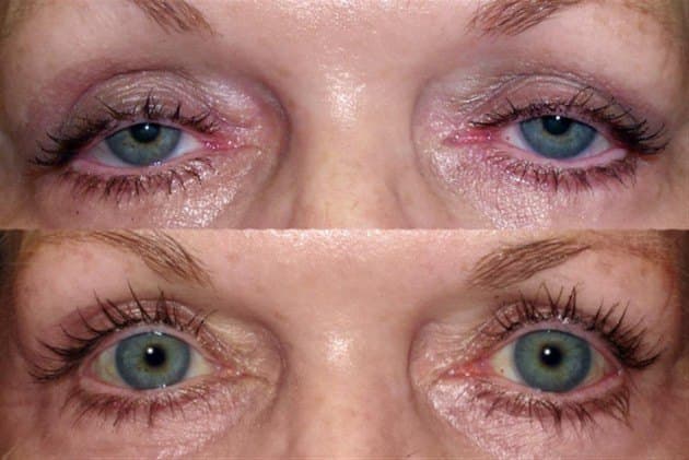 Age 52 — before and after ptosis repair