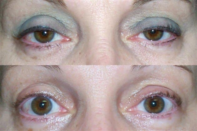 Age 59 — before and after ptosis repair