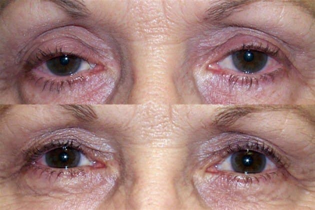 Age 70 — before and after ptosis repair