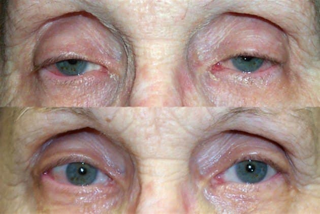 Age 86 — before and after ptosis repair