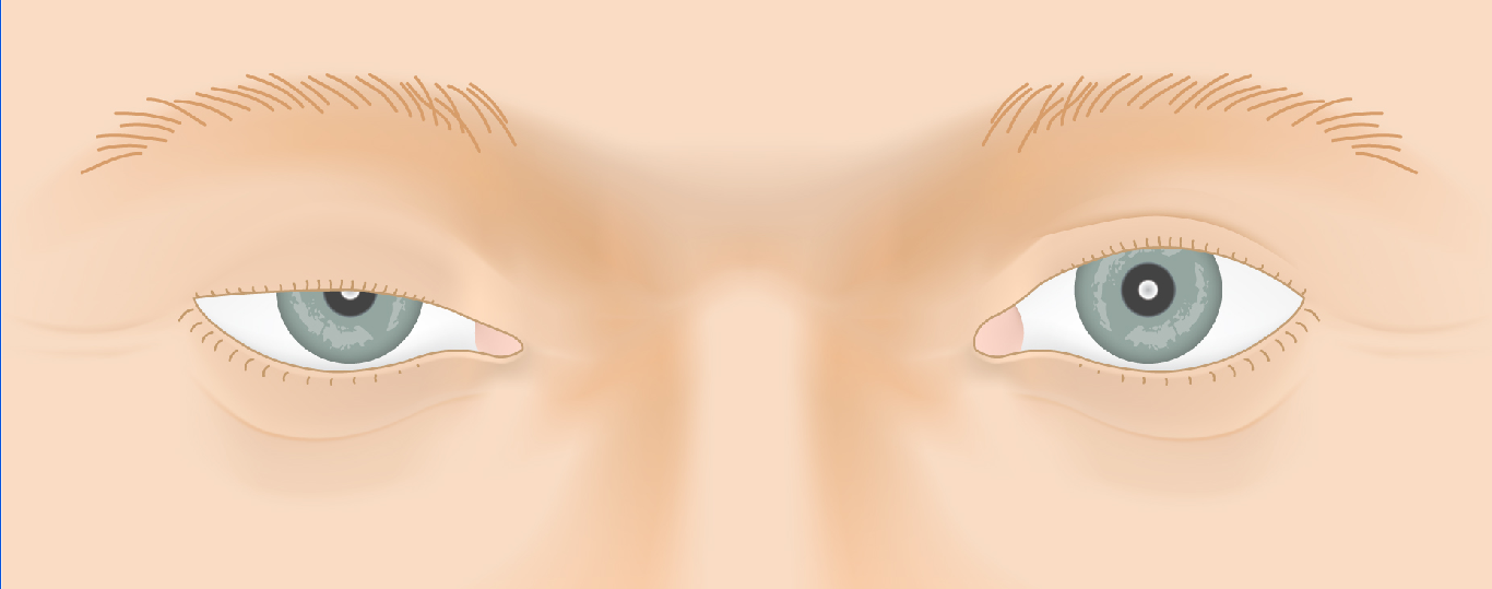 ptosis_law1