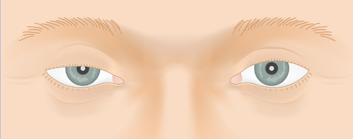 ptosis_law2