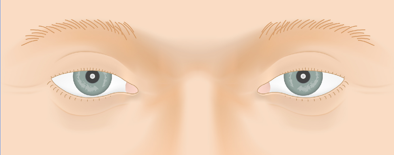 ptosis_law3