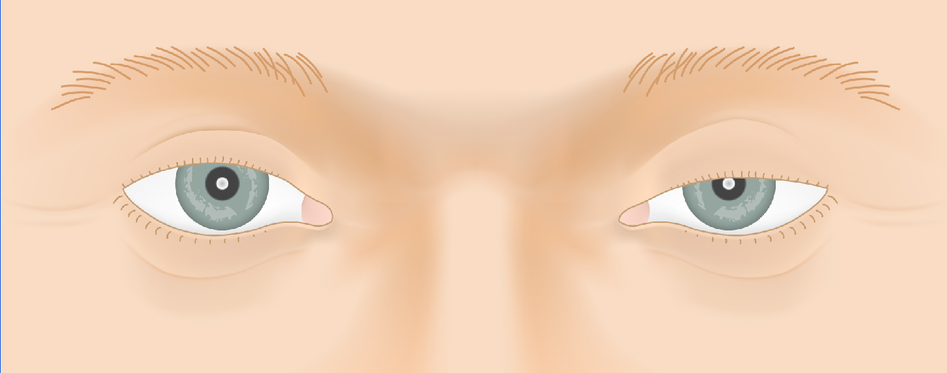 ptosis_law4