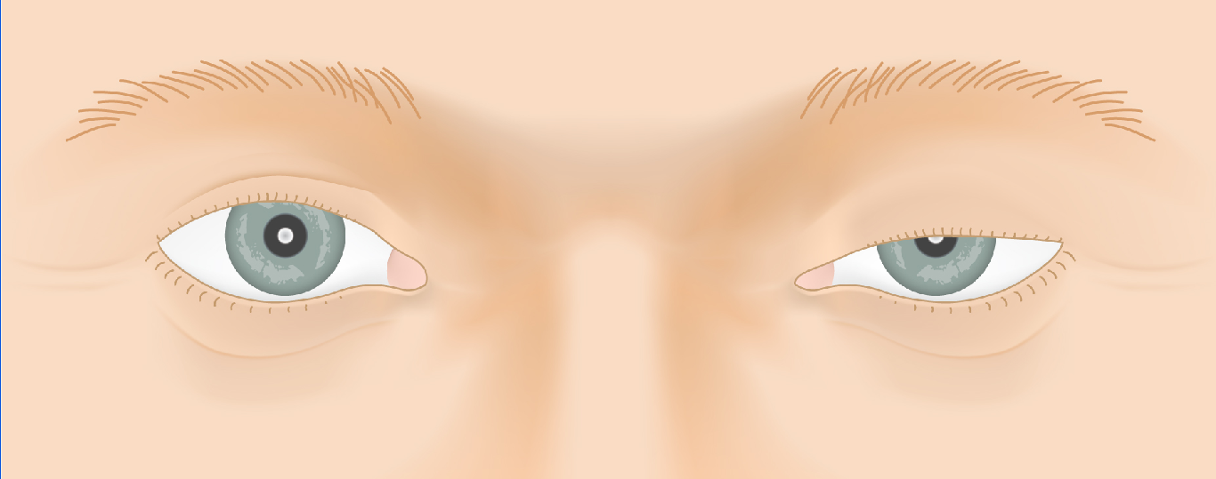 ptosis_law5