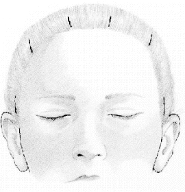 Endoscopic brow lift — step 2