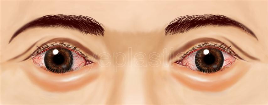 Clinical photograph of entropion &mdash; lower eyelid turning inward
