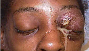 Herpes zoster ophthalmicus &mdash; dermatomal rash involving the forehead and eyelid