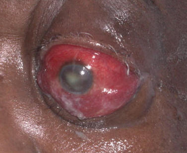 Orbital cellulitis &mdash; periorbital swelling, erythema, and proptosis