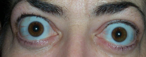 Thyroid eye disease &mdash; orbital CT